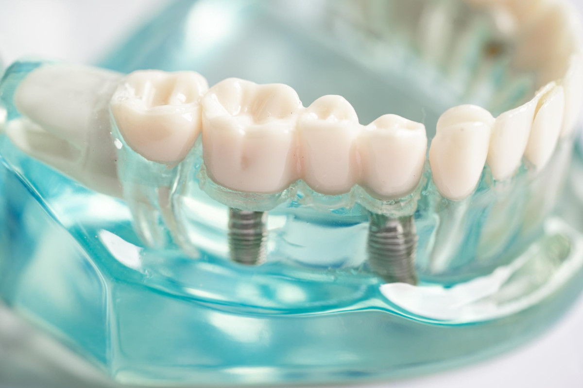 zahn implantatbehandlung